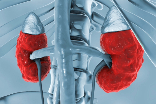 Hematuria