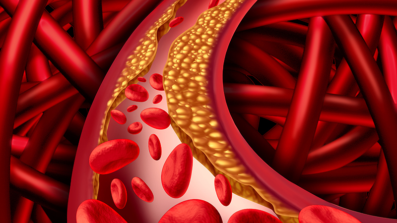 What is the treatment for Heart Blockage?
