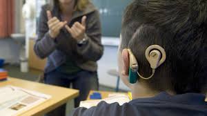 cochlear implant