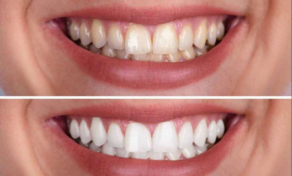 crest whitestrips