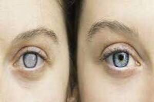 Glaucoma Can Now Be Treated Easily With Careprost