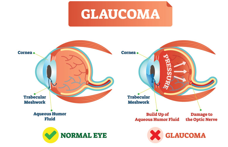 glaucoma