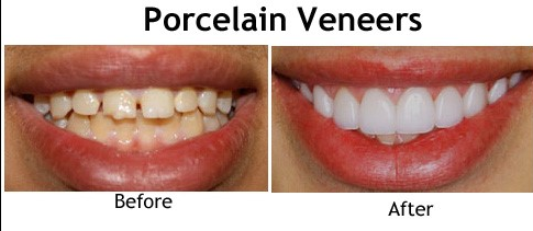 Porcelain Teeth veneers