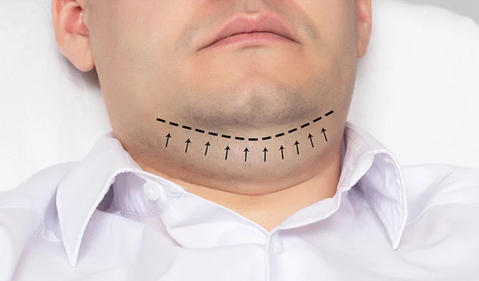 Double chin due to Genetics issue